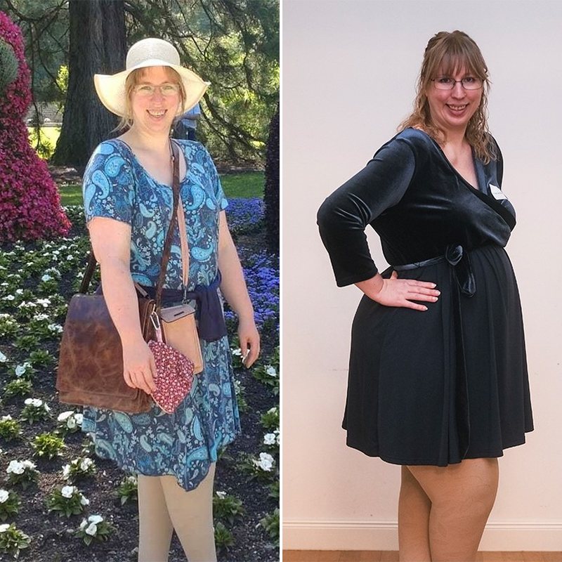 Photo for the review, lipedema · pregnancy